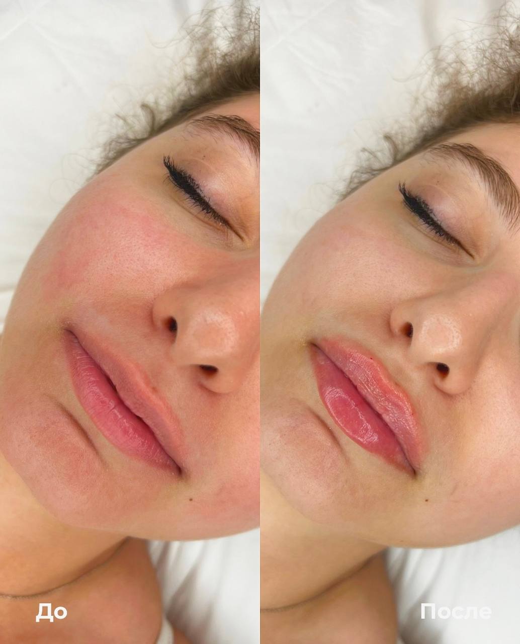 Увеличение и коррекция губ фото 5