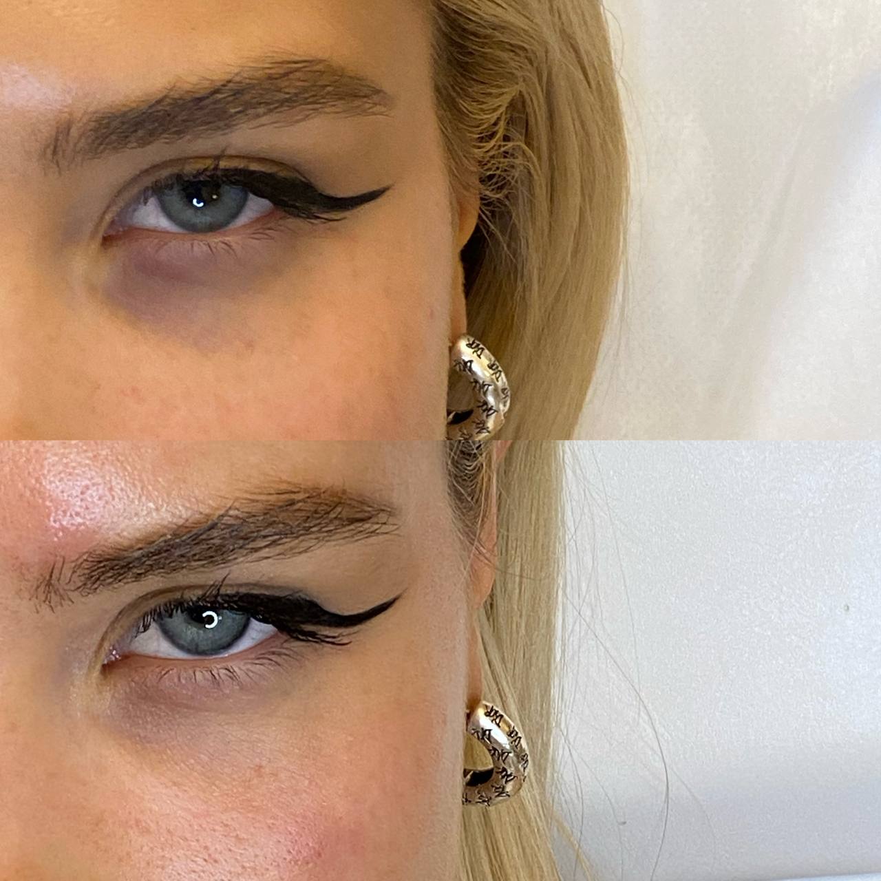 Коррекция темных кругов под глазами фото 1