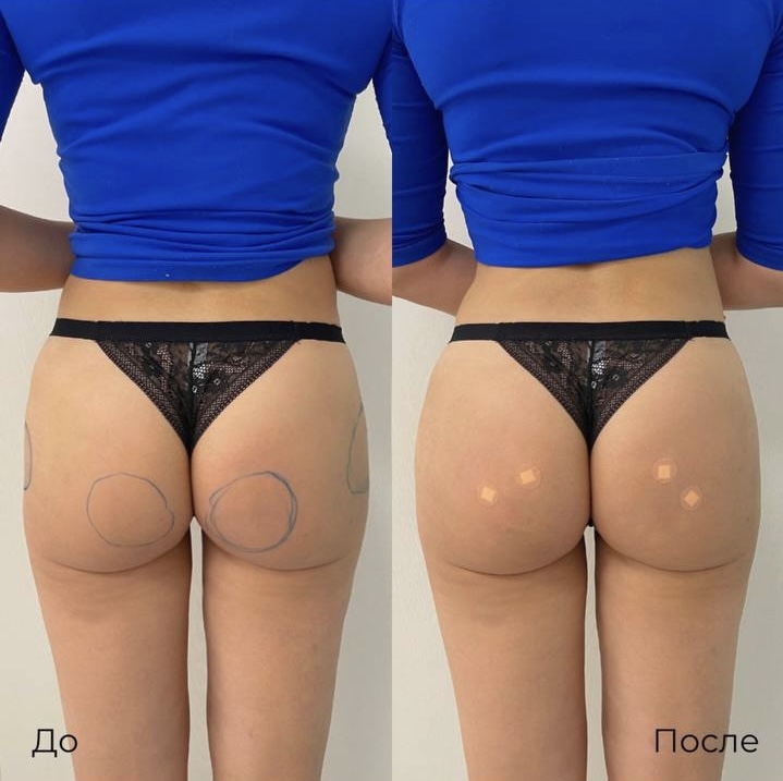 Увеличение и коррекция ягодиц фото 2