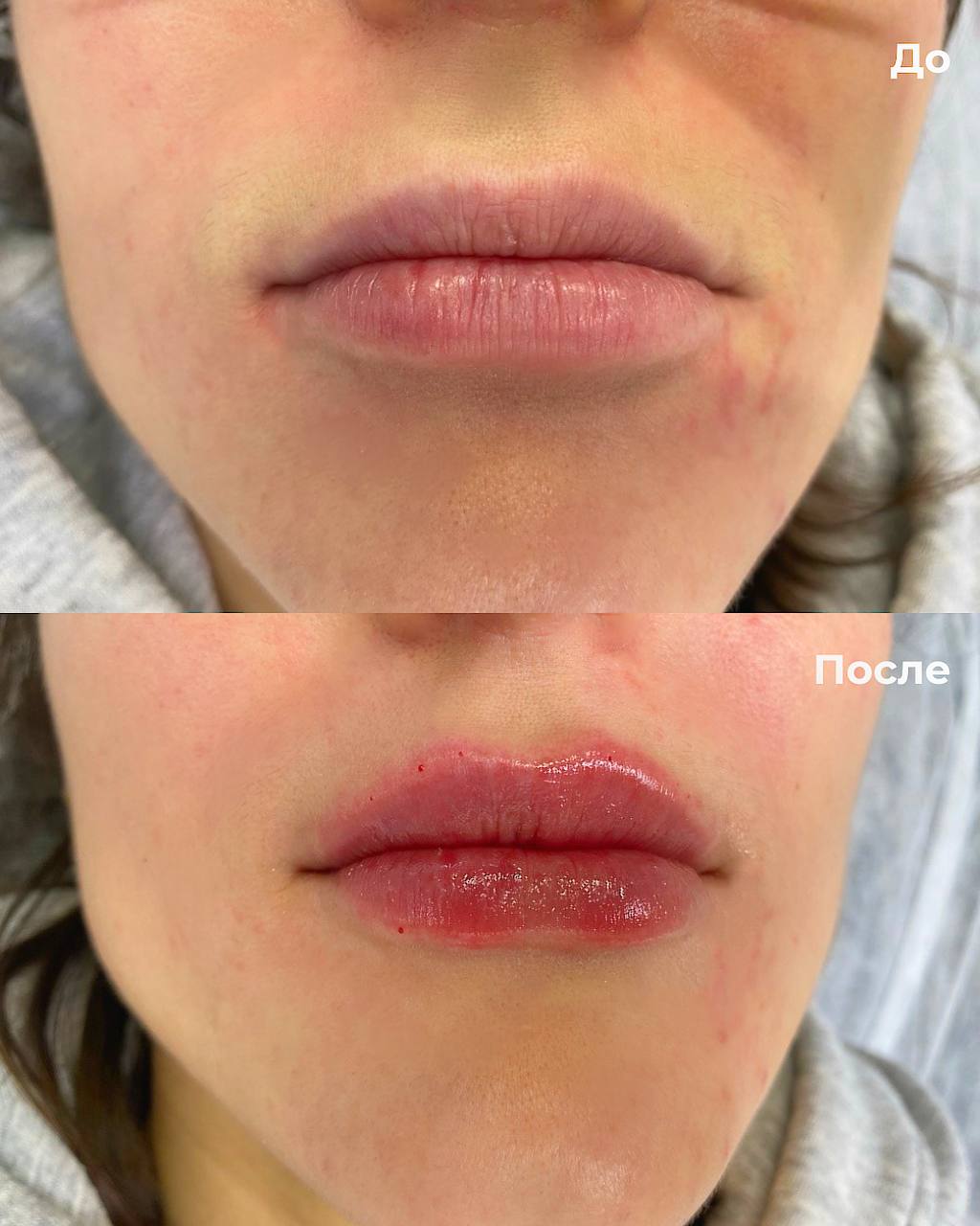 Увеличение и коррекция губ фото 9