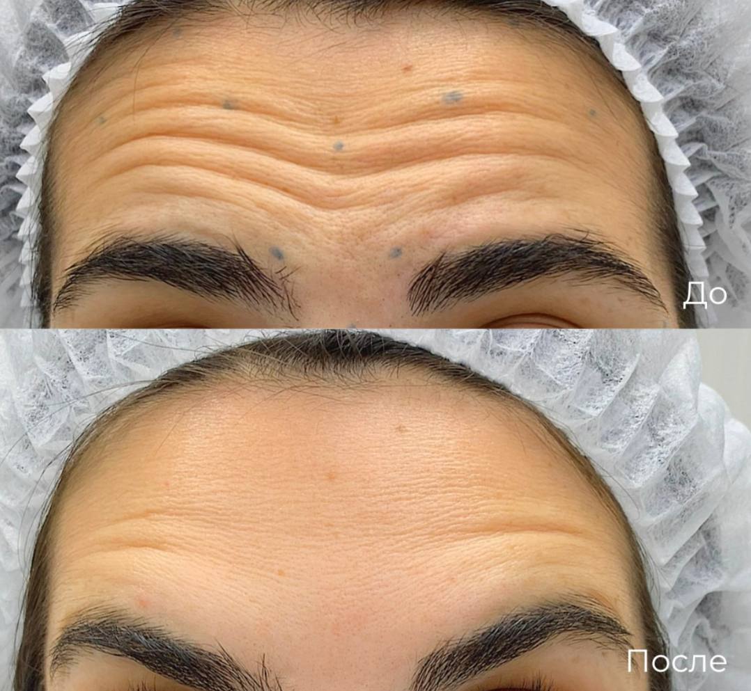 Коррекция мимических морщин фото 2