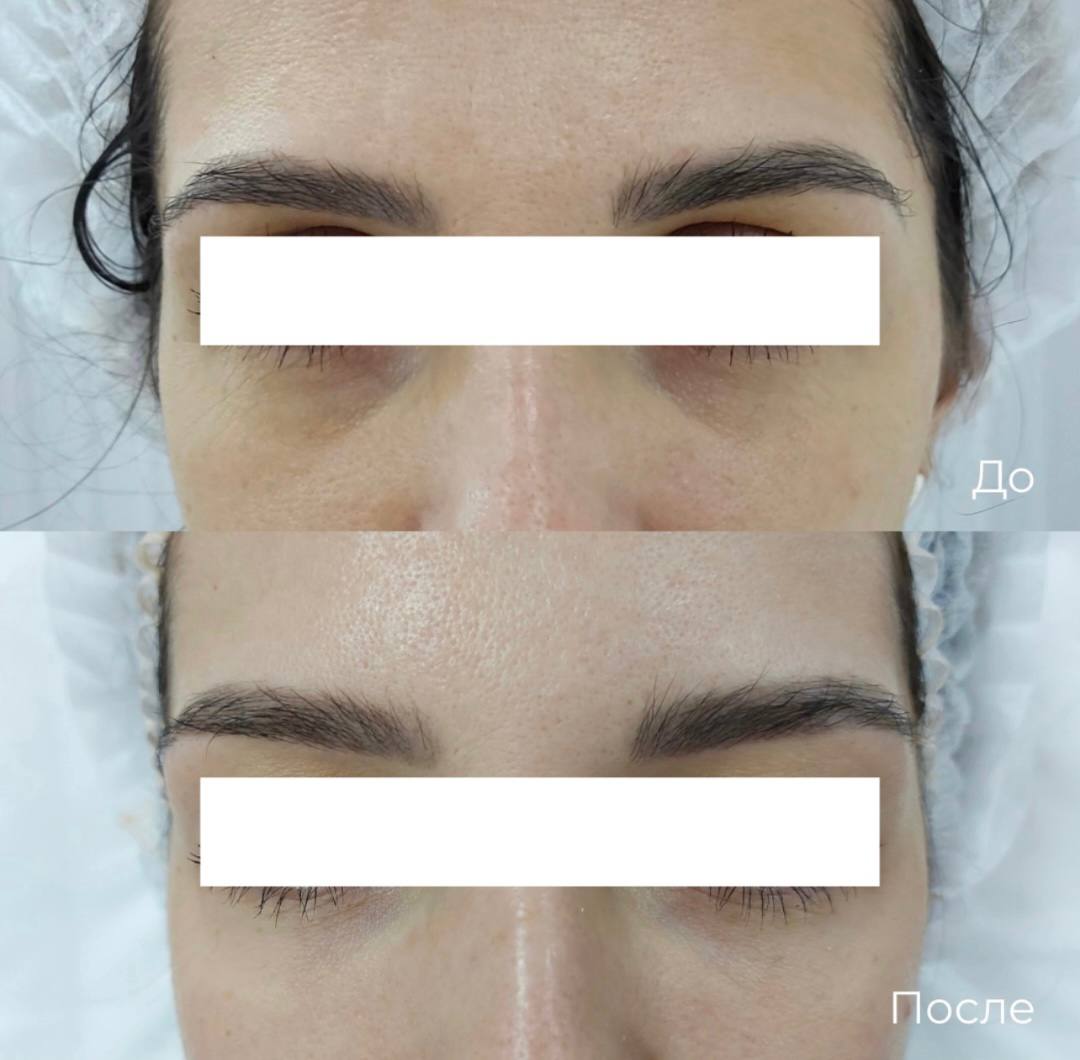 Коррекция темных кругов под глазами фото 9