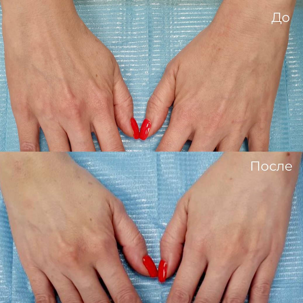 Омоложение кожи рук фото 2