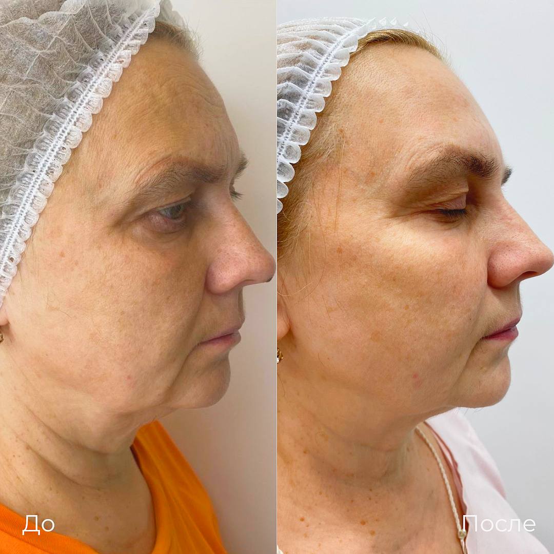 SMAS лифтинг лица Ultraformer фото 13