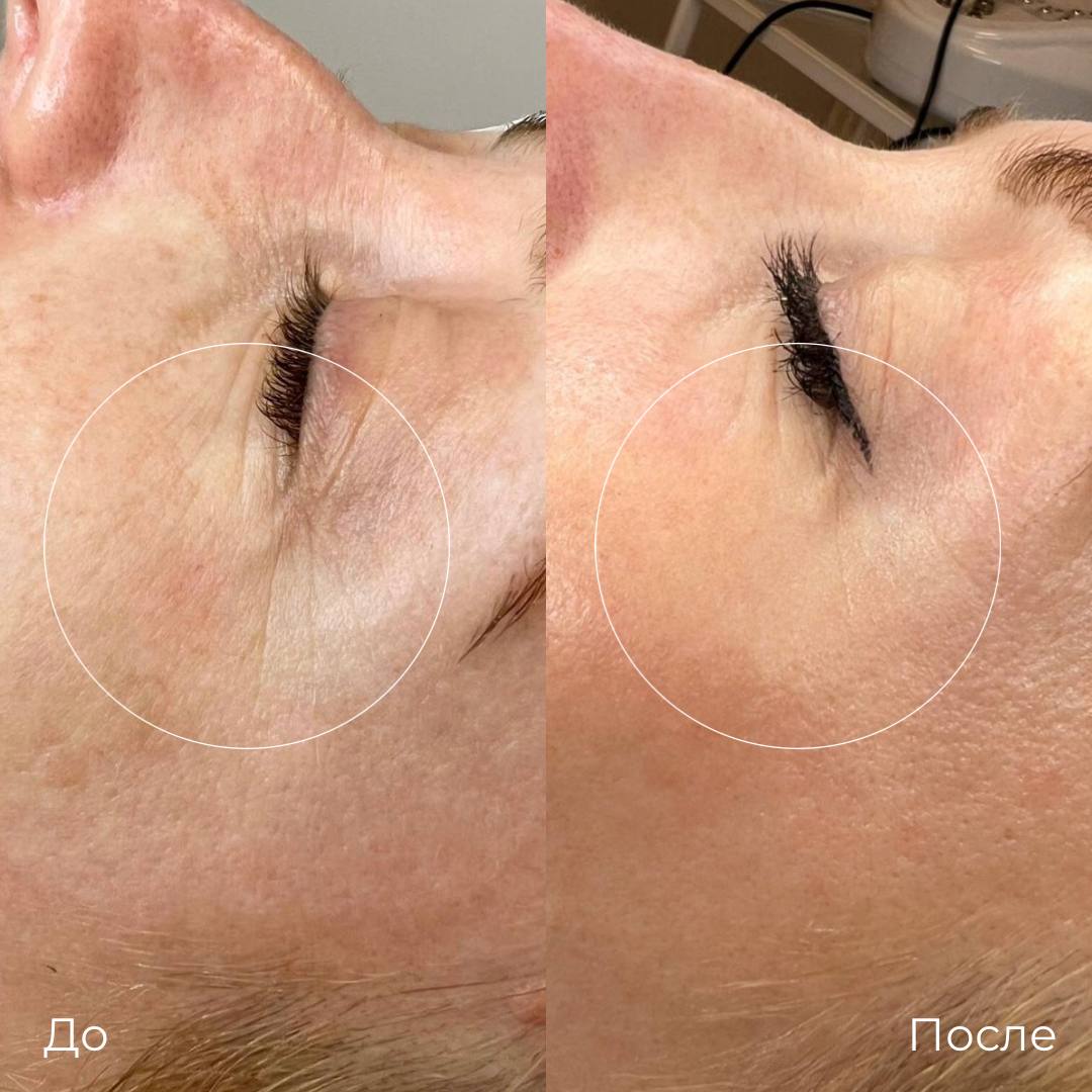 Лазерная шлифовка СО2 фото 2