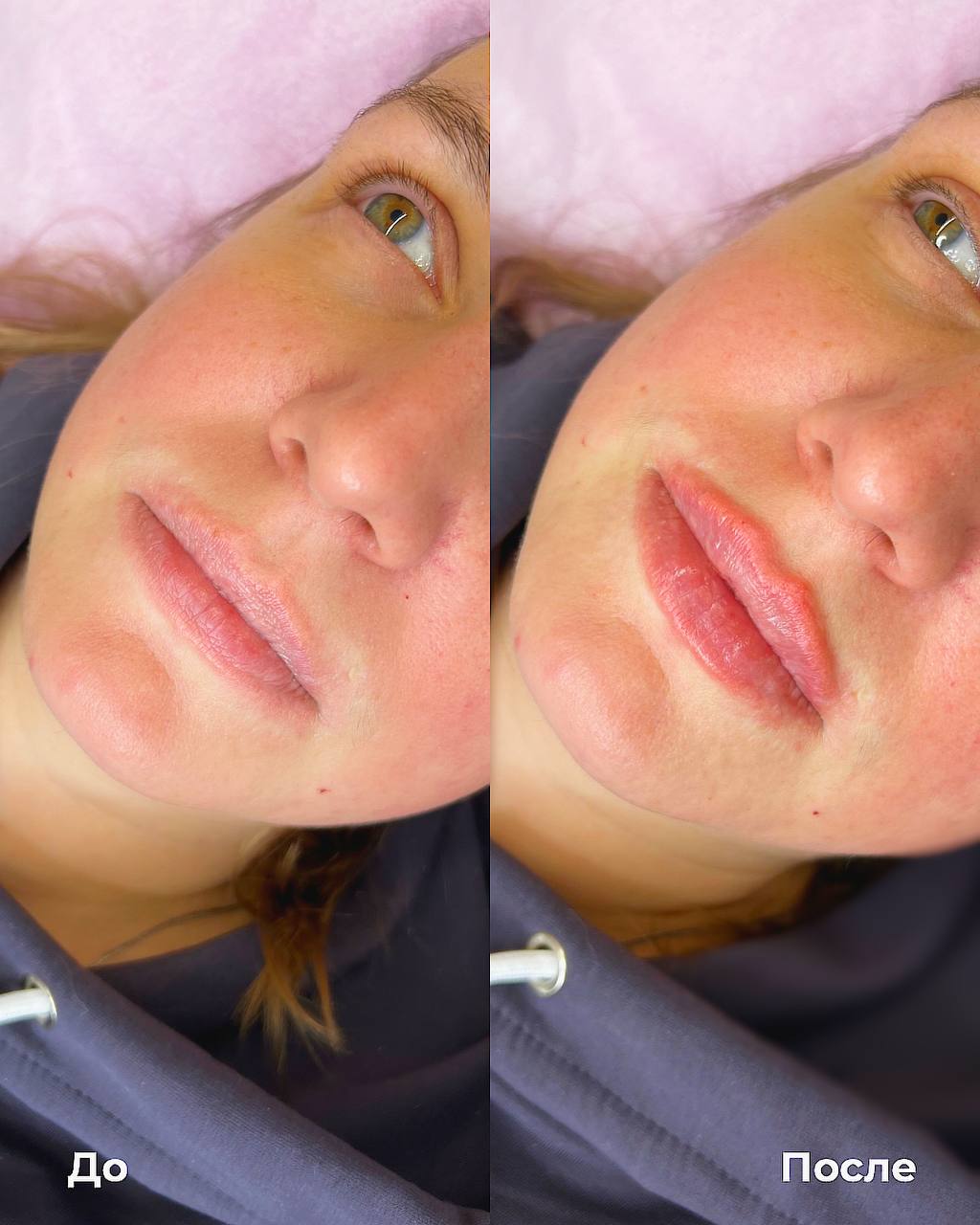 Увеличение и коррекция губ фото 11