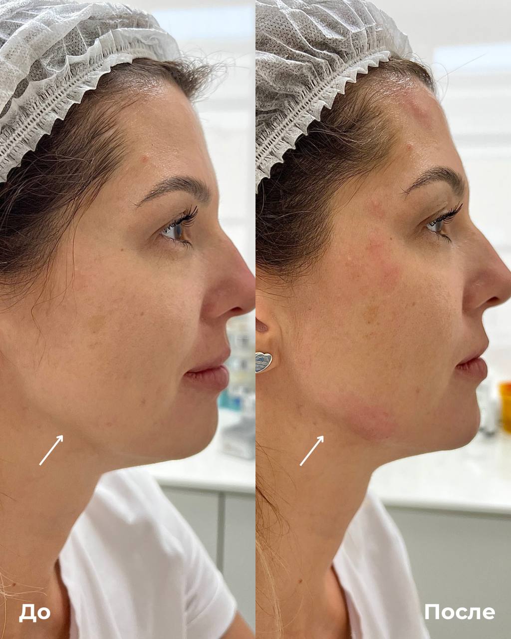 Контурная пластика лица фото 5