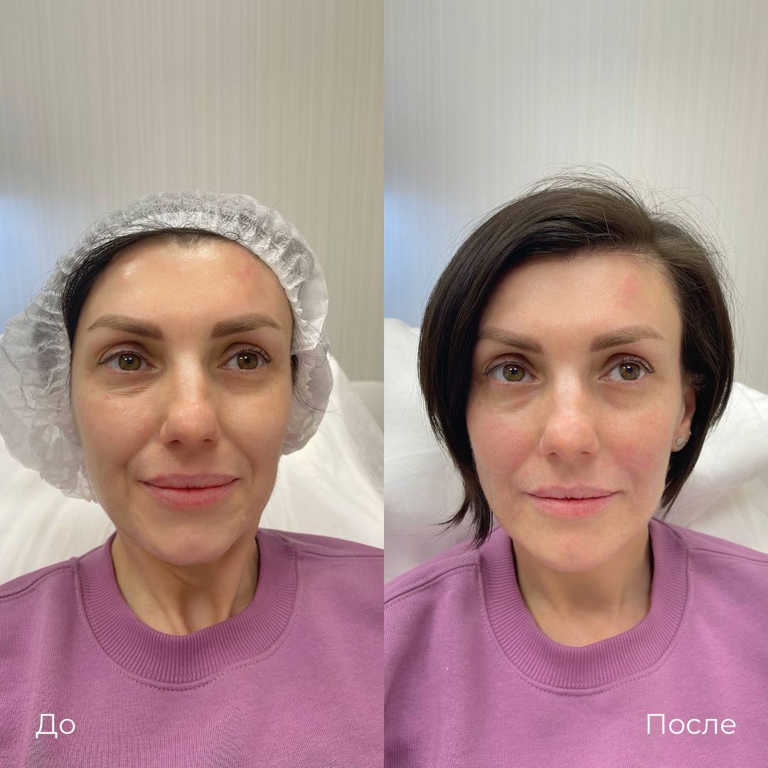 Контурная пластика лица фото 13
