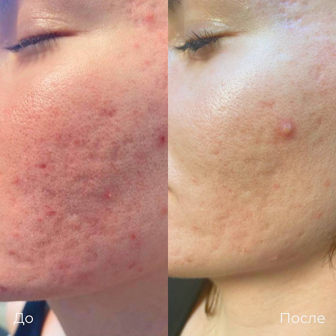 Субцизия фото 3