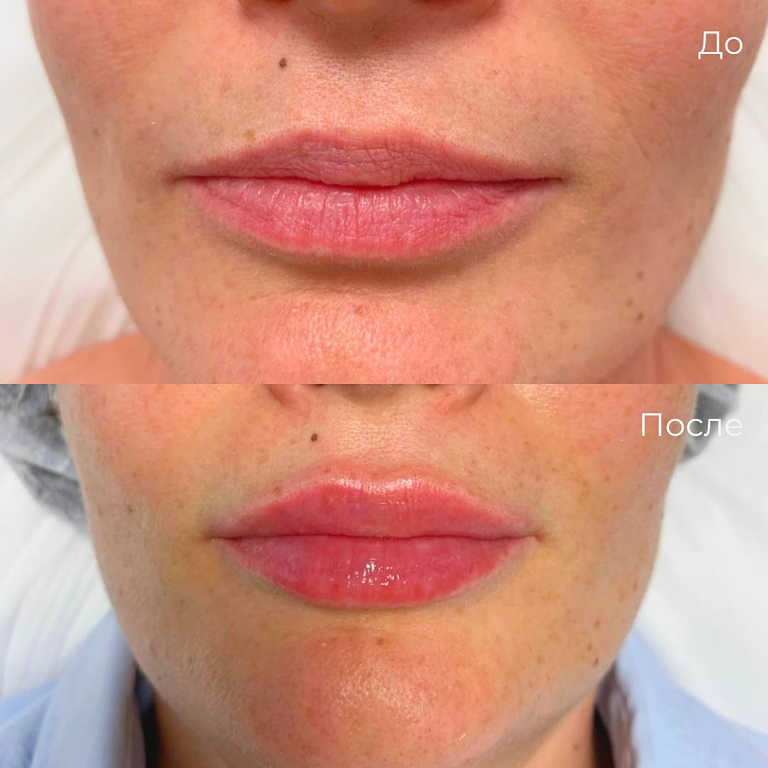 Увеличение и коррекция губ фото 33