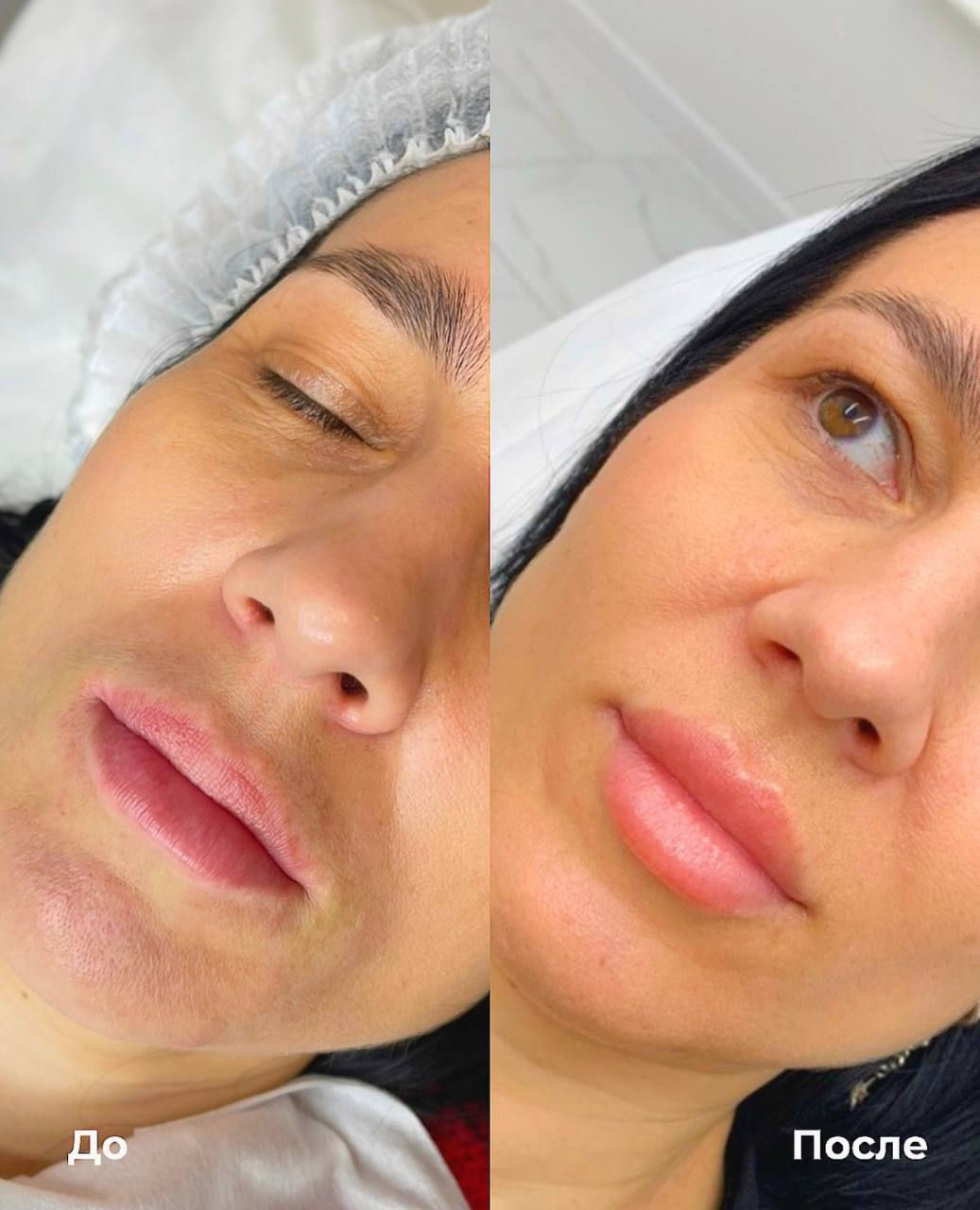 Увеличение и коррекция губ фото 4
