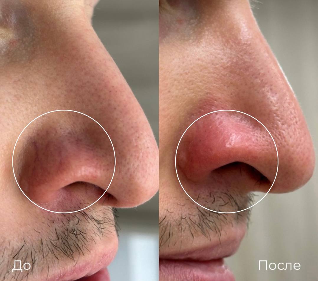 Фототерапия купероза фото 15