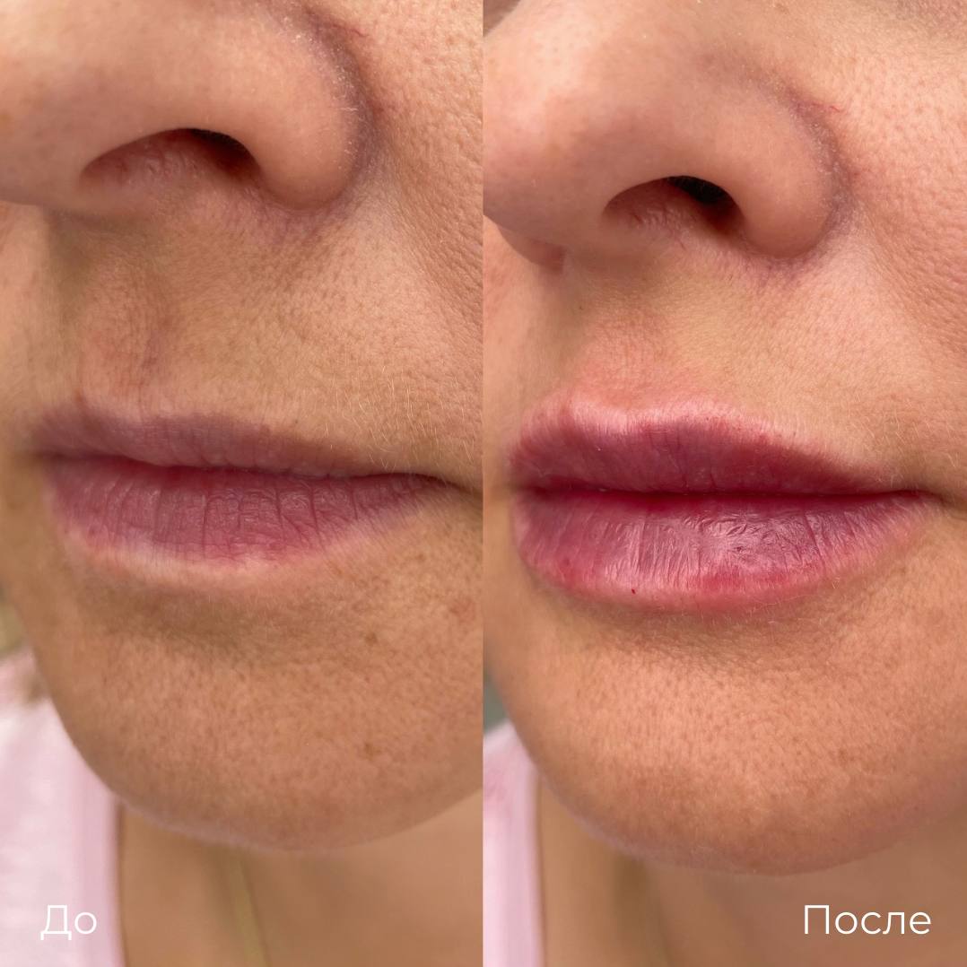 Увеличение и коррекция губ фото 28