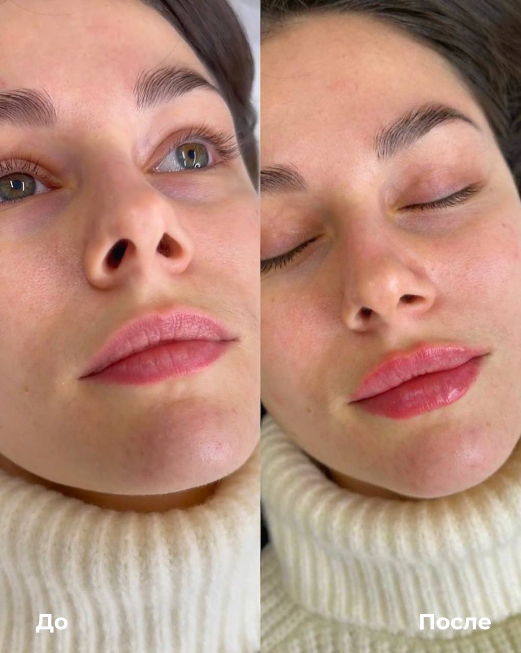 Увеличение и коррекция губ фото 7