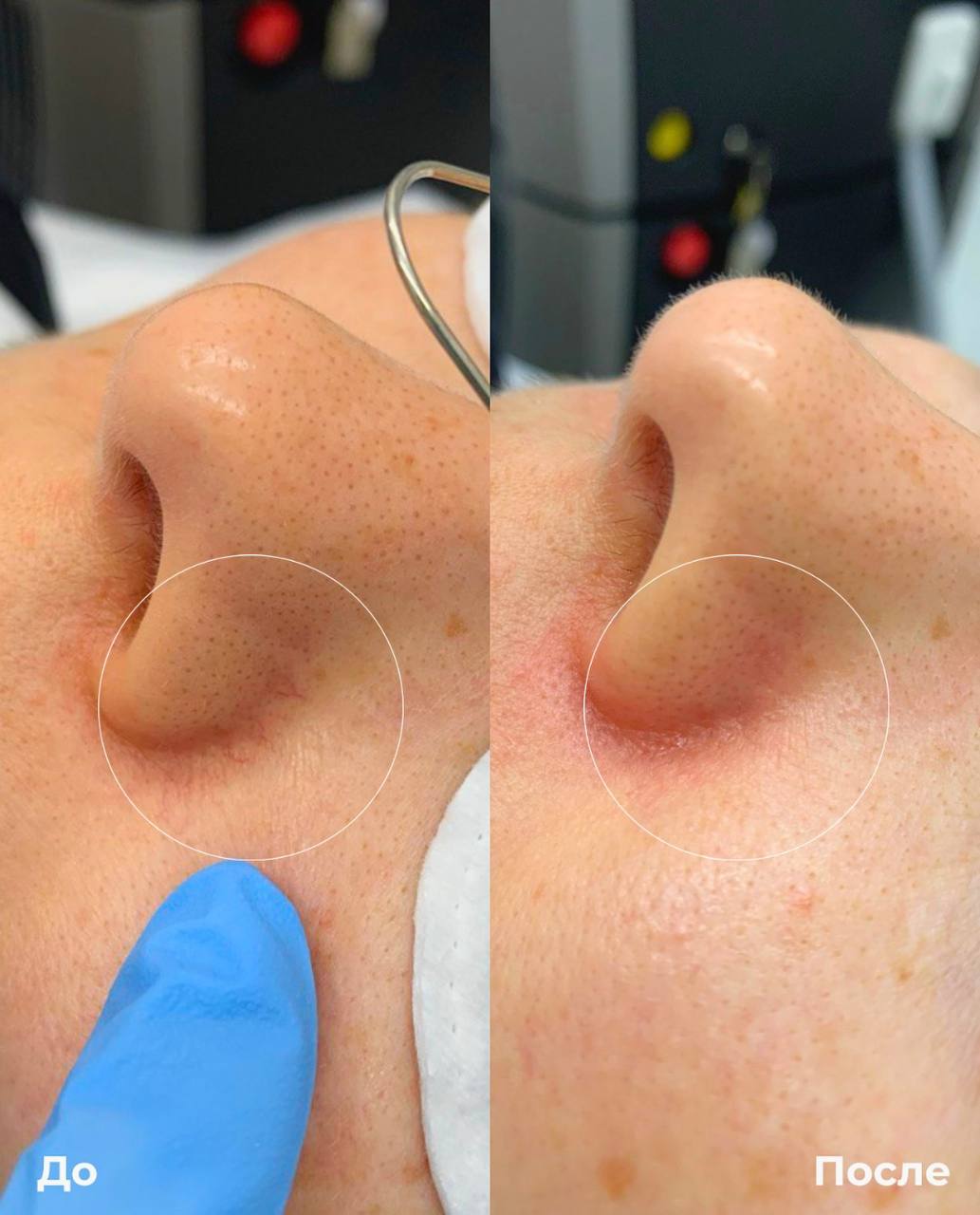Фототерапия купероза фото 10
