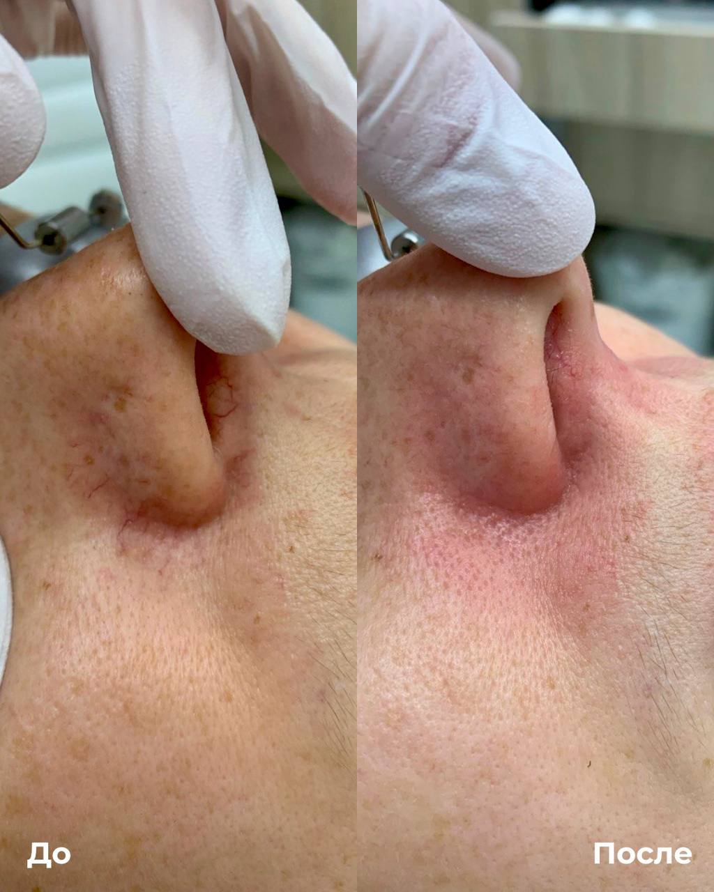 Фототерапия купероза фото 4