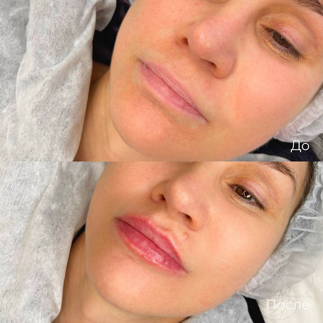 Увеличение и коррекция губ фото 29