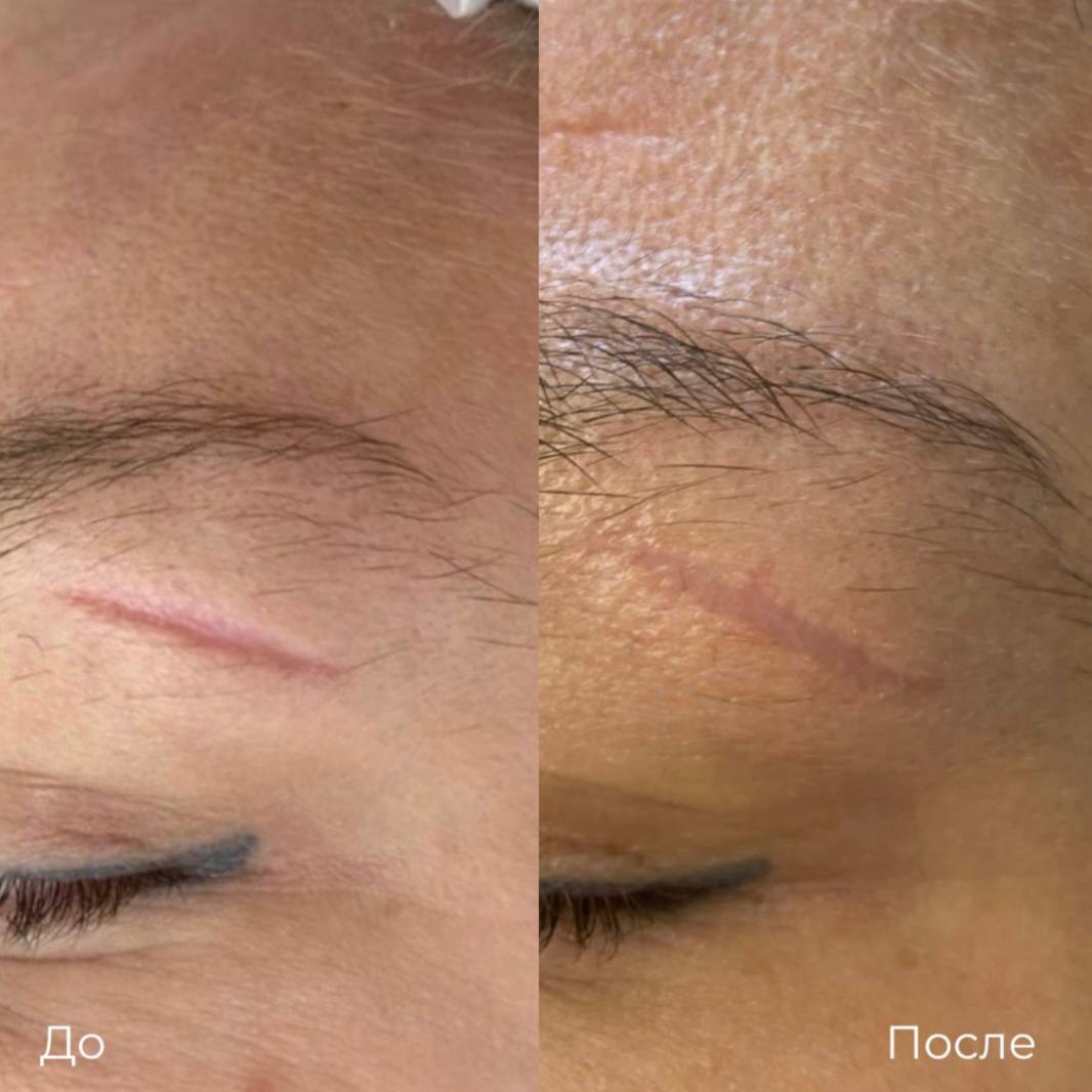 Субцизия фото 8