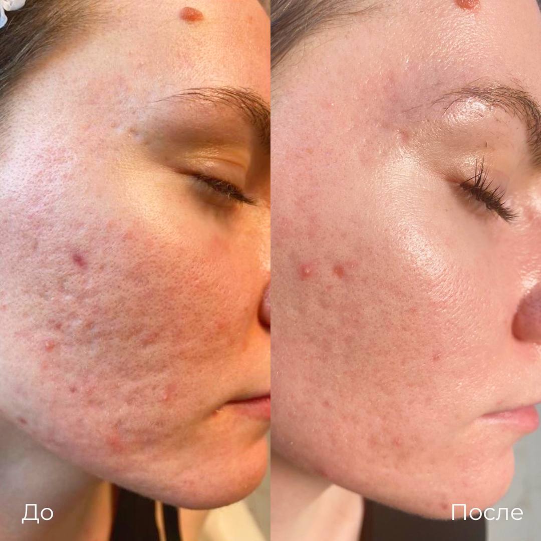 Субцизия фото 2