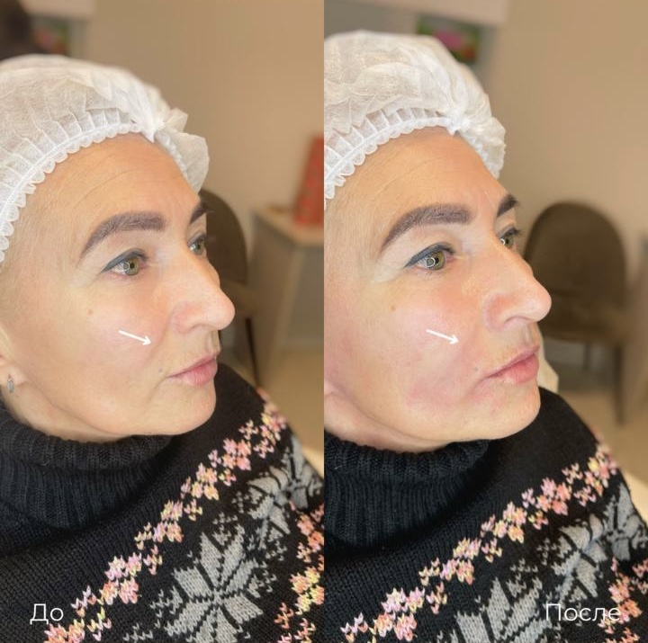 Контурная пластика лица фото 7