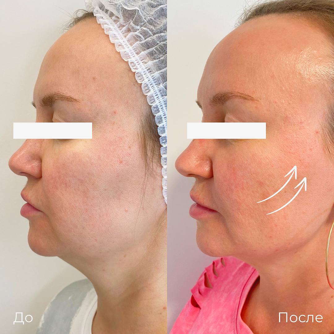 SMAS лифтинг лица Ultraformer фото 10
