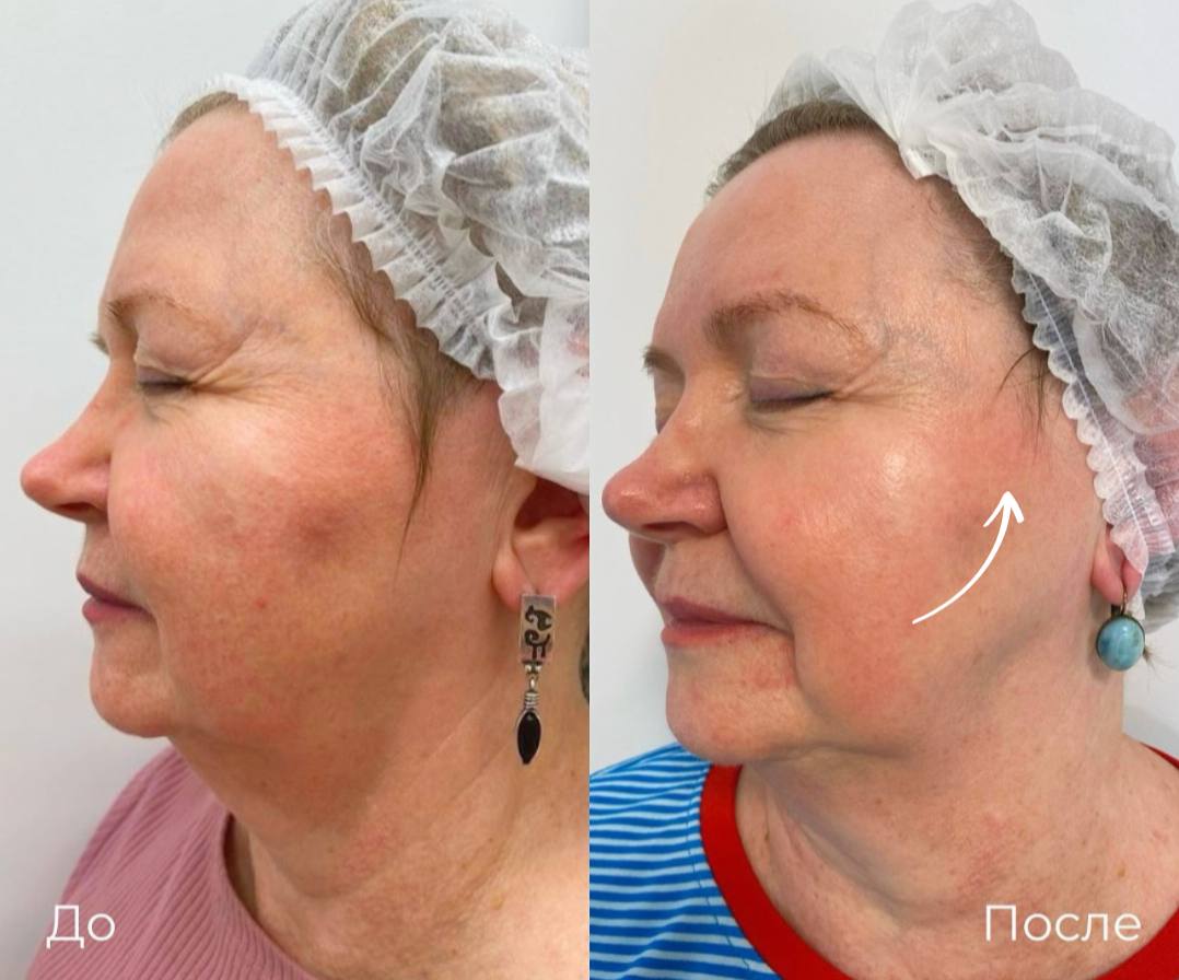SMAS лифтинг лица Ultraformer фото 7