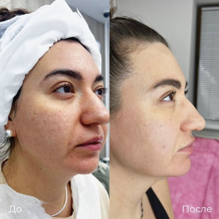 SMAS лифтинг лица Ultraformer фото 2