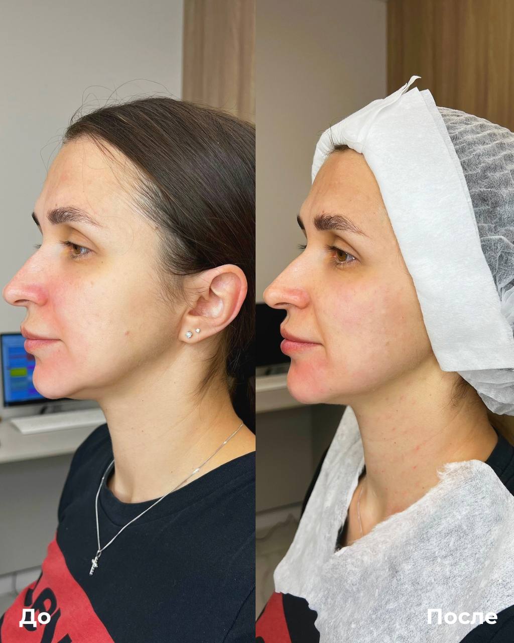 Биоревитализация фото 4