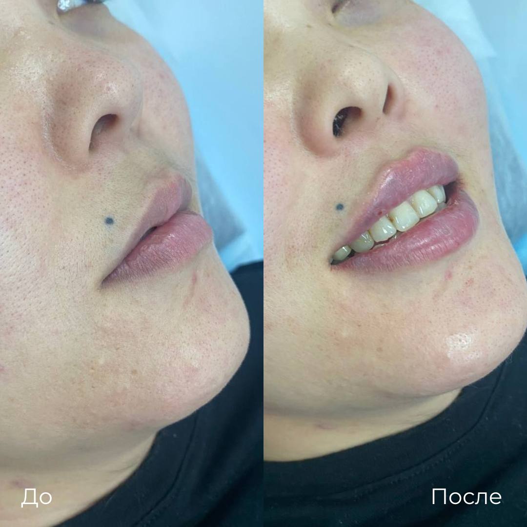 Увеличение и коррекция губ фото 23