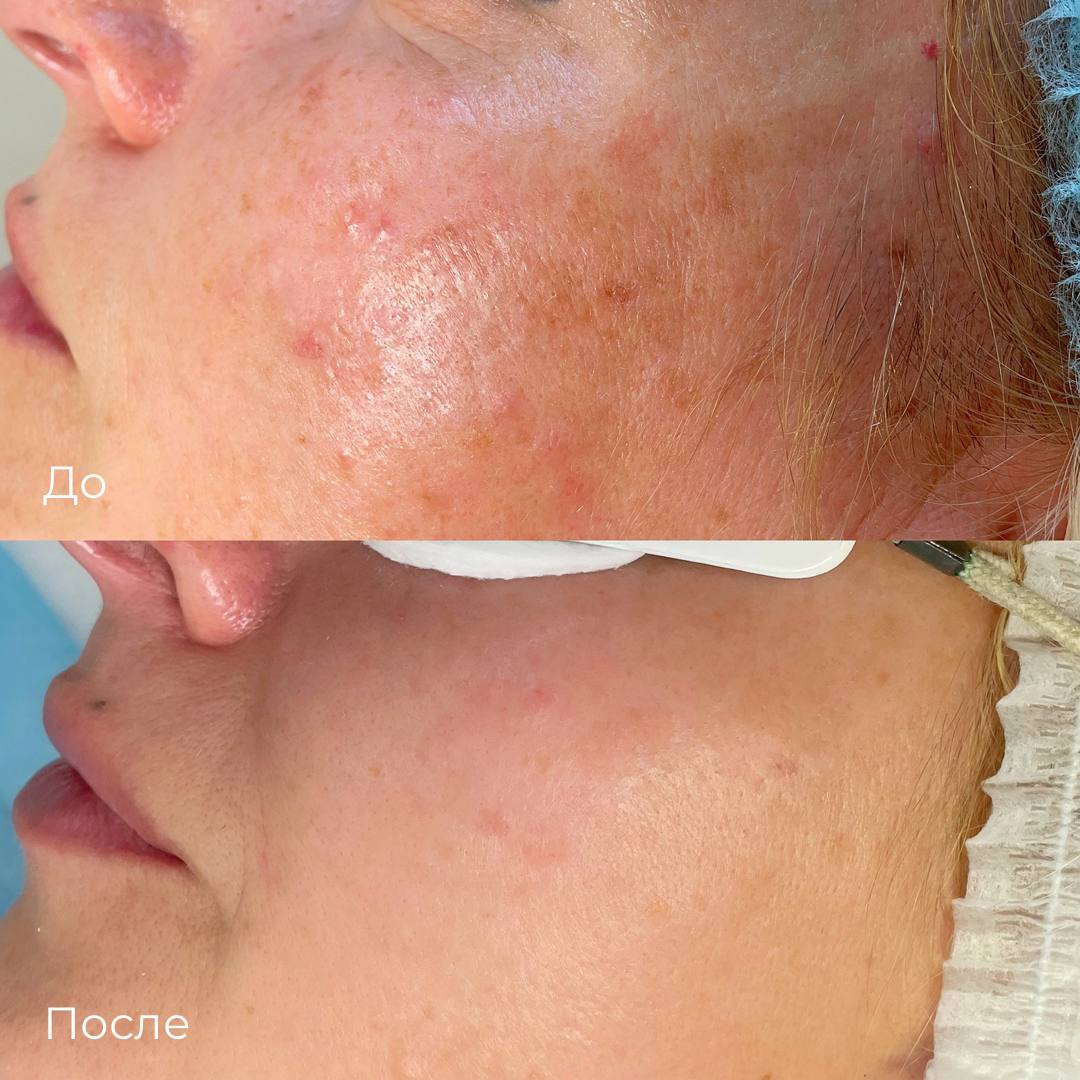 Фототерапия от пигментных пятен фото 3