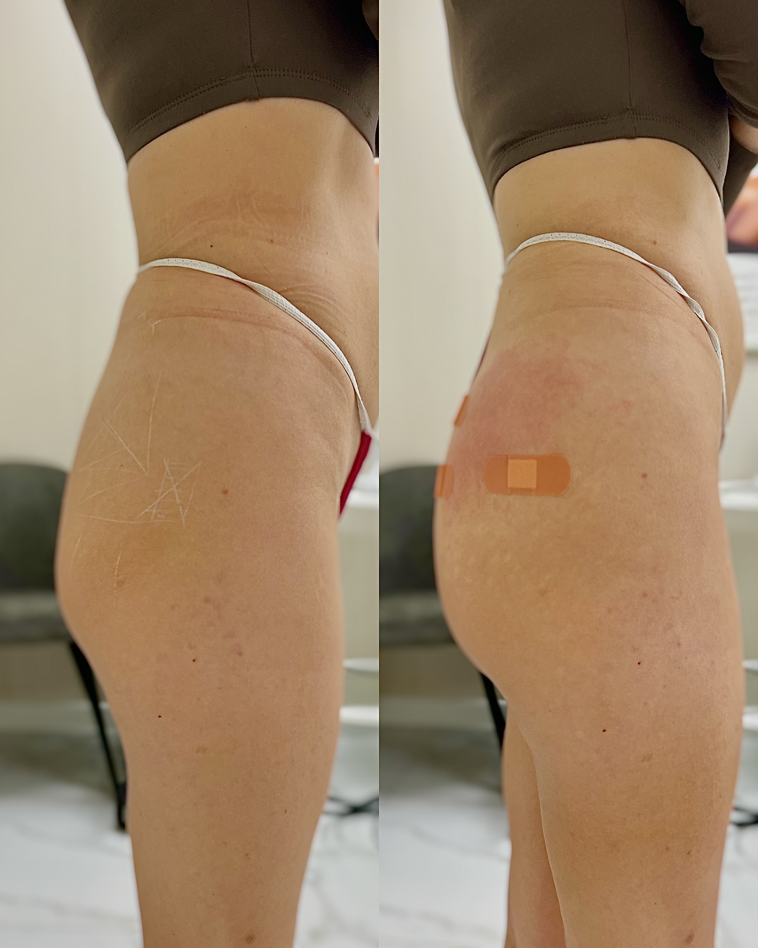 Увеличение и коррекция ягодиц фото 3