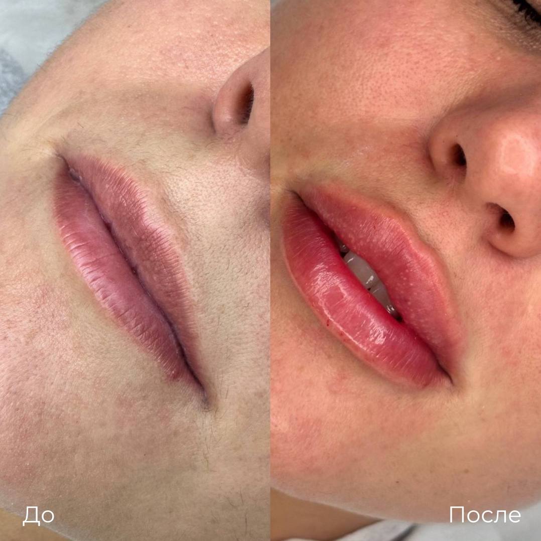 Увеличение и коррекция губ фото 26