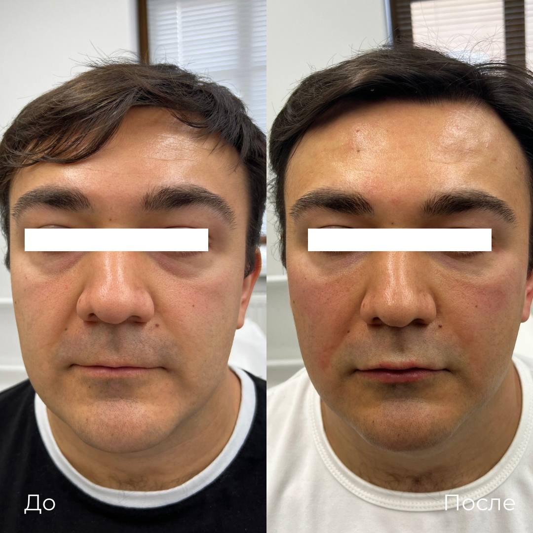 Коррекция темных кругов под глазами фото 5