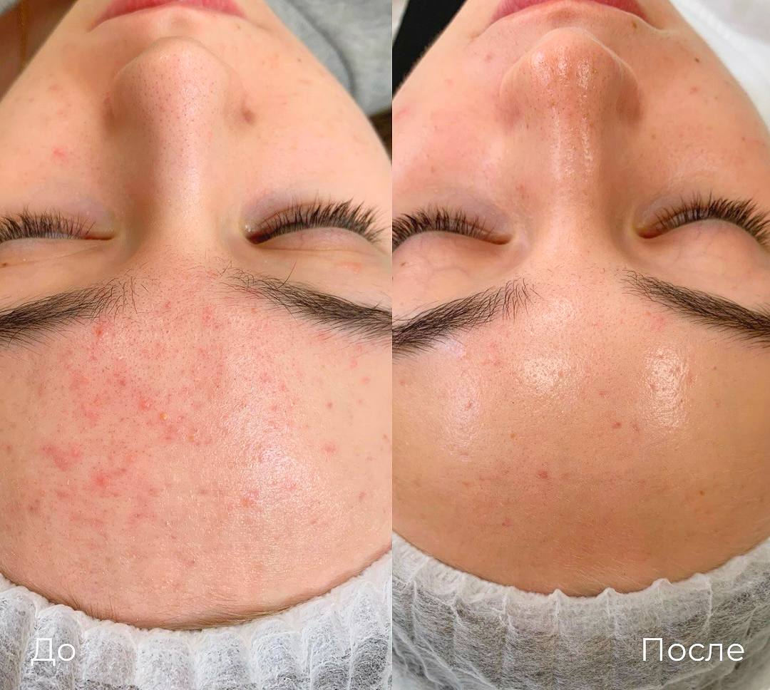 Лазерное лечение акне фото 8