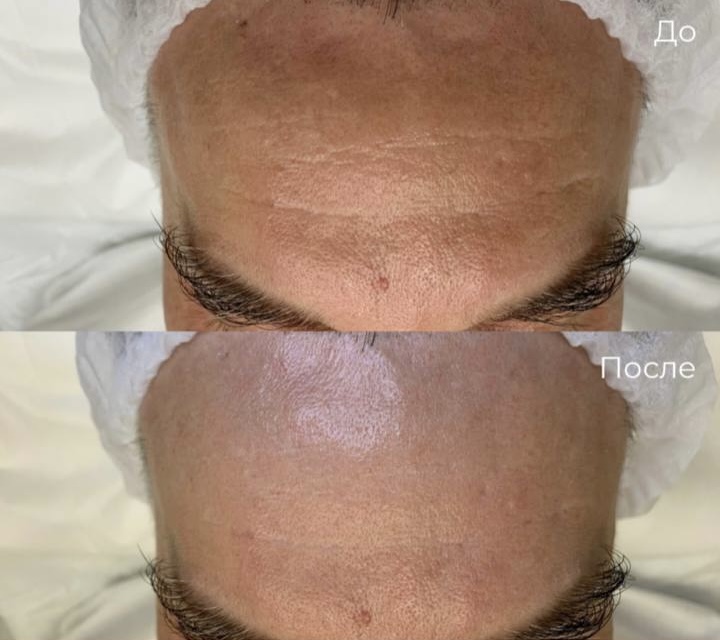 Контурная пластика лица фото 12