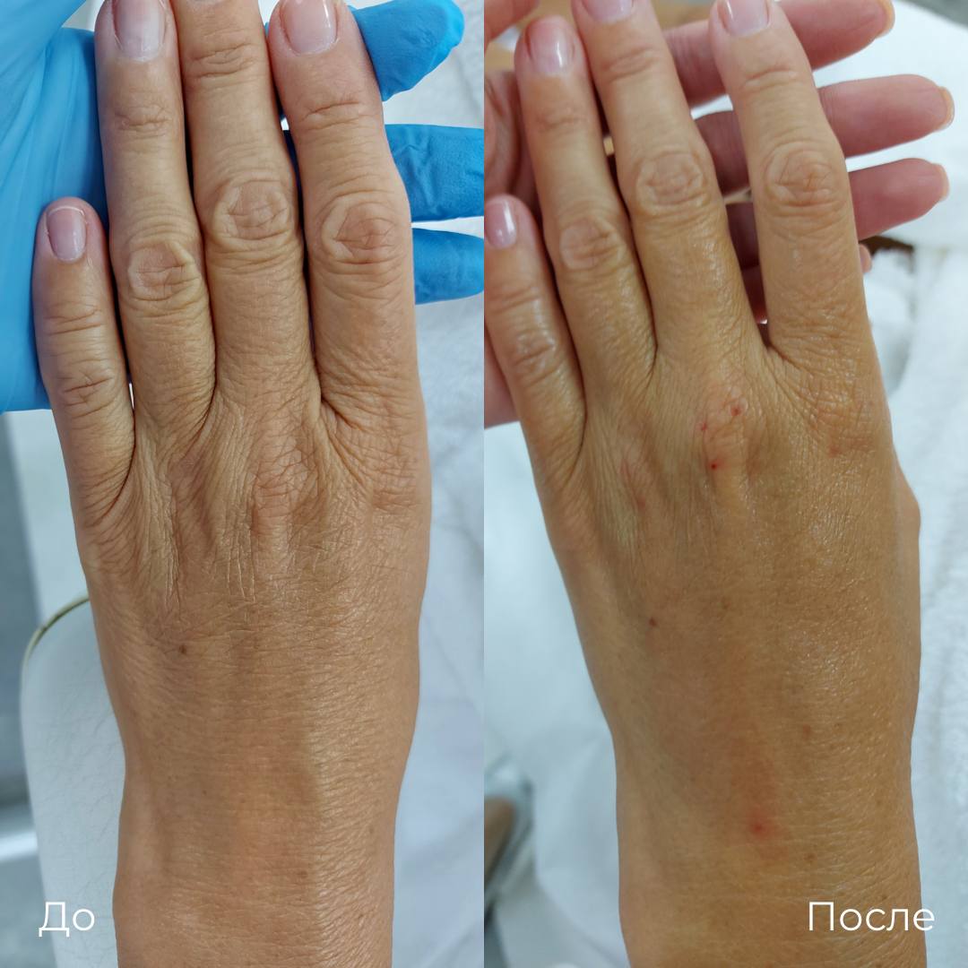Омоложение кожи рук фото 1
