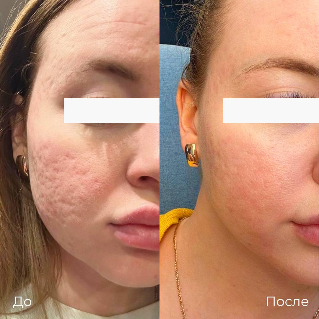 Субцизия фото 6