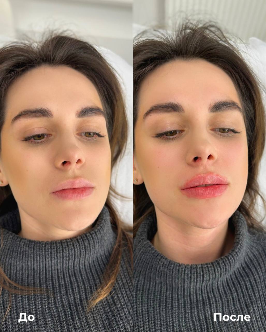 Увеличение и коррекция губ фото 8