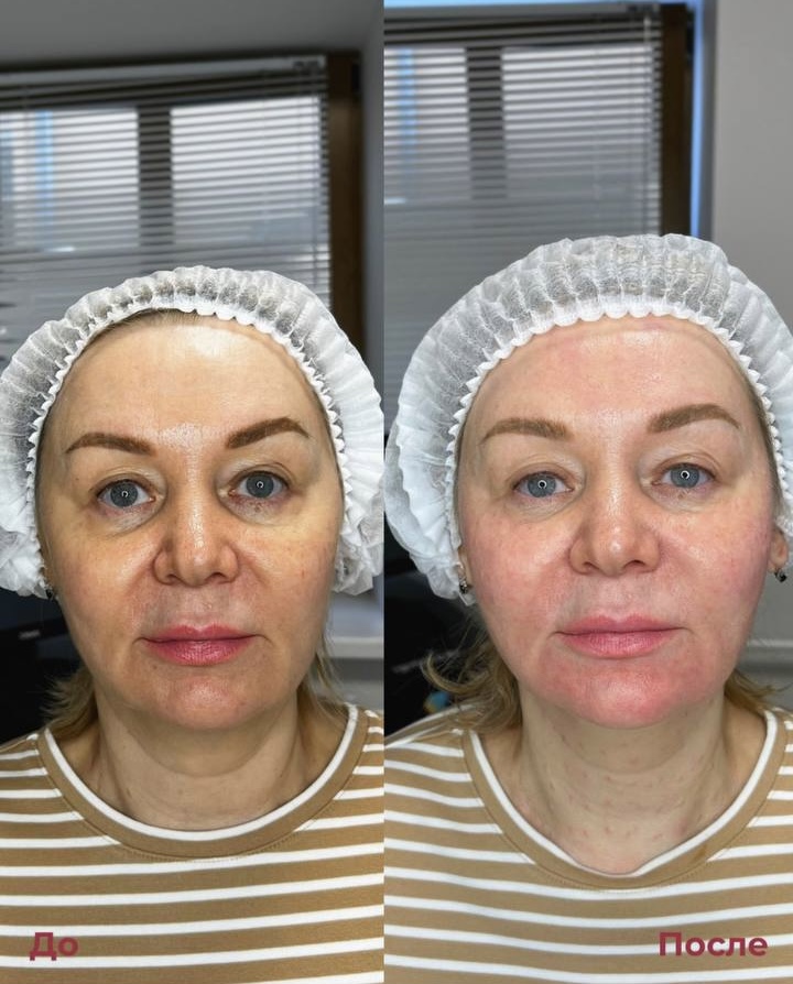 Биоревитализация фото 2