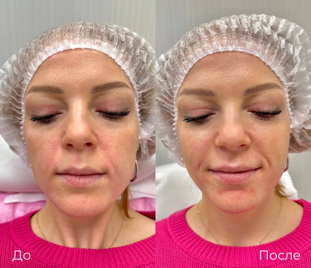 Контурная пластика лица фото 1