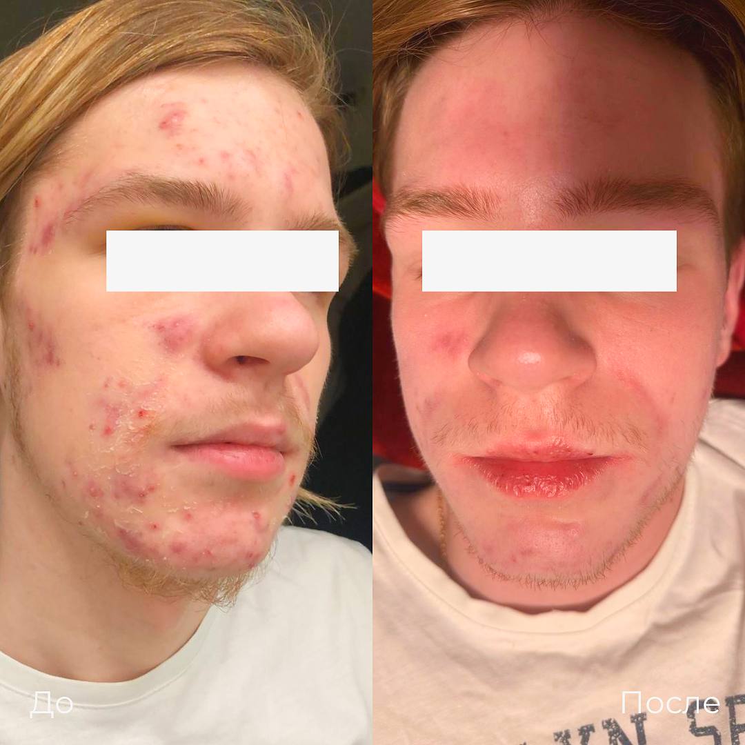 Лазерное лечение акне фото 9
