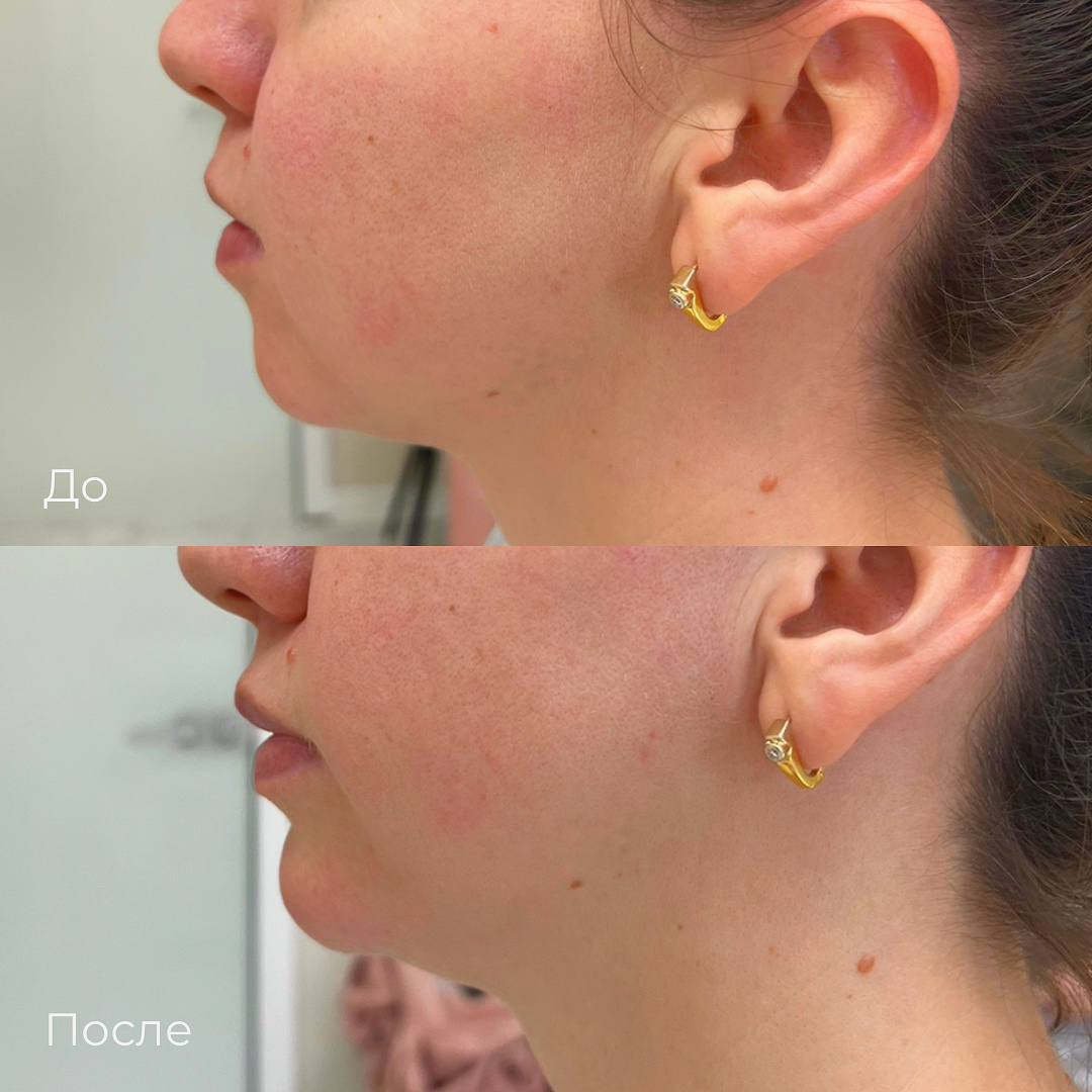 Контурная пластика лица фото 8