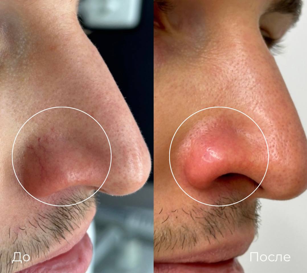 Фототерапия купероза фото 14