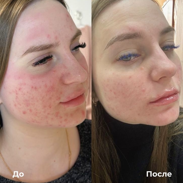 Лазерное лечение акне фото 4
