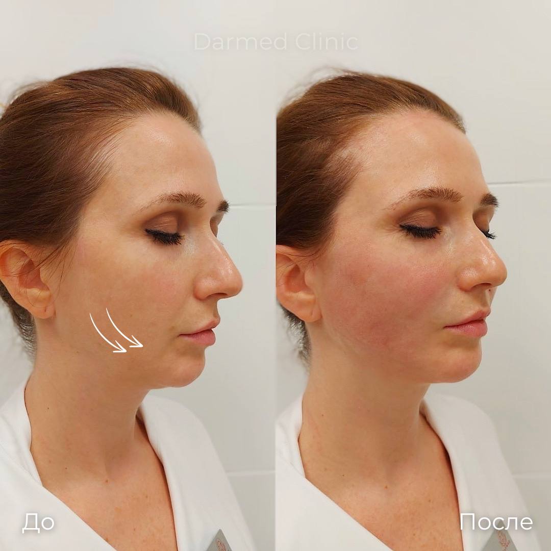 Мезонити фото 3