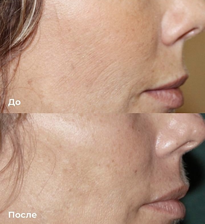 Игольчатый РФ-лифтинг фото 1