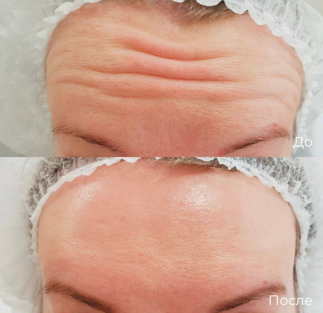 Коррекция мимических морщин фото 1