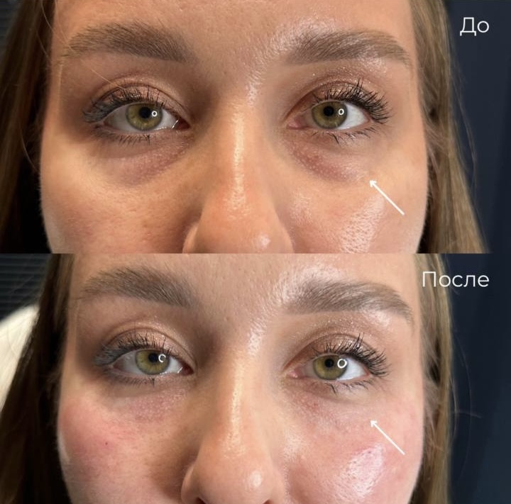 Коррекция темных кругов под глазами фото 10