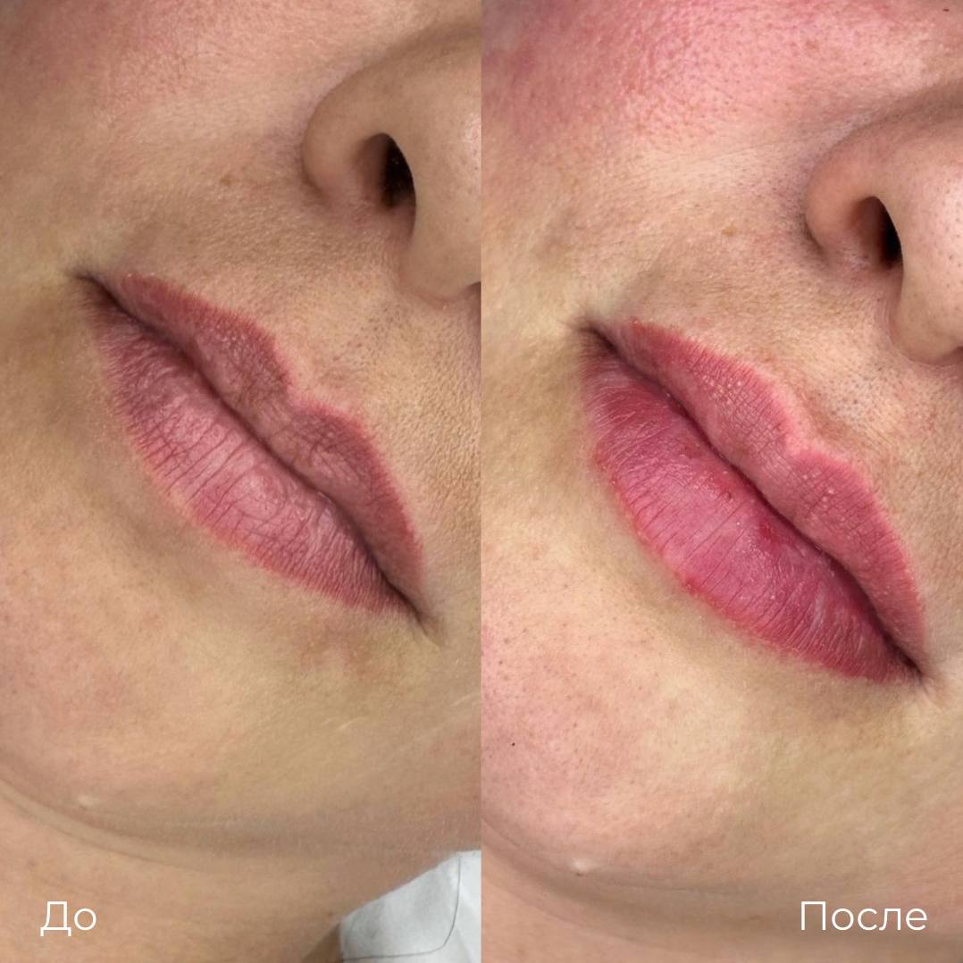 Увеличение и коррекция губ фото 27
