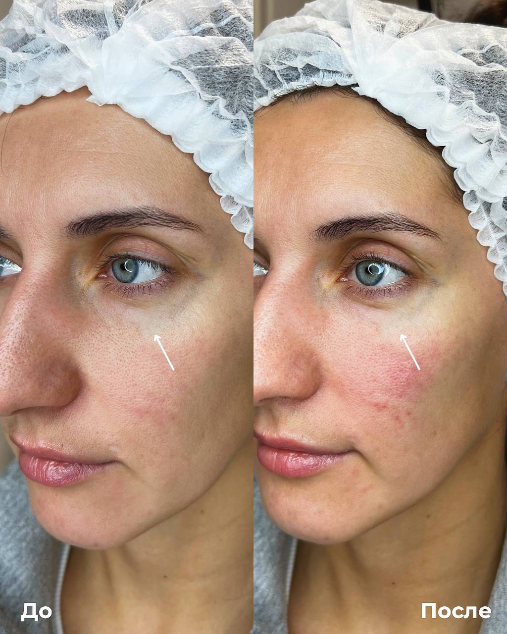 Коррекция темных кругов под глазами фото 4